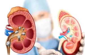 इंसानों में सुअर की किडनी ट्रांसप्लांट का पहला क्लीनिकल ट्रायल शुरू, मेडिकल साइंस की नई क्रांति