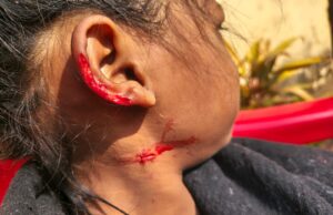 आवारा कुत्तों के आतंक से दहला दल्ली राजहरा, बच्चे पर हमले के बाद भी एक्शन नहीं