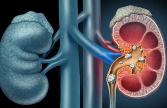 गर्मियों में डिहाइड्रेशन से बढ़ता किडनी स्टोन का खतरा: जानिए कारण और बचाव