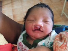 जब चिरायु टीम बनी एक परिवार की उम्मीद, जन्मजात विकृति से जूझ रहे बच्चे को मिला नया जीवन