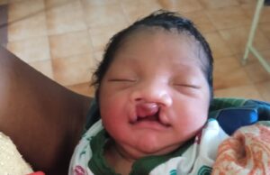 जब चिरायु टीम बनी एक परिवार की उम्मीद, जन्मजात विकृति से जूझ रहे बच्चे को मिला नया जीवन