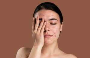 पिंपल्स से छुटकारा पाने के लिए नेचुरल फेस पैक: दही, केसर और एलोवेरा का असरदार उपाय