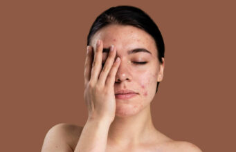 पिंपल्स से छुटकारा पाने के लिए नेचुरल फेस पैक: दही, केसर और एलोवेरा का असरदार उपाय