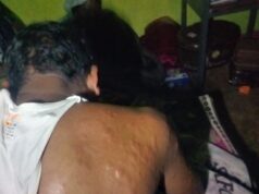 बेमौसम तूफान का कहर: आंधी-ओलावृष्टि में दंपत्ति घायल, एक-दूसरे को थामकर बचाई जान