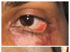 स्किन ग्राफ्टिंग से मरीज के पलक का सफल पुनर्निर्माण