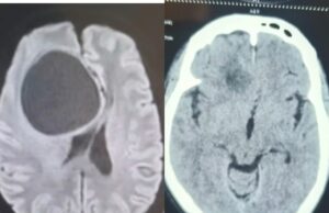 ब्रेन तक पहुंची सेरिब्रल टीबी, सीसीएसएच में मिला नया जीवन