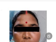 सिम्स में 38 वर्षीय महिला के रेडिकुलर सिस्ट का सफल उपचार, दांत की पुरानी सड़न से जबड़े में बनी थी बड़ी सिस्ट, आधुनिक तकनीक से बिना हड्डी को नुकसान पहुंचाए निकाला गया सिस्ट