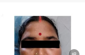 सिम्स में 38 वर्षीय महिला के रेडिकुलर सिस्ट का सफल उपचार, दांत की पुरानी सड़न से जबड़े में बनी थी बड़ी सिस्ट, आधुनिक तकनीक से बिना हड्डी को नुकसान पहुंचाए निकाला गया सिस्ट
